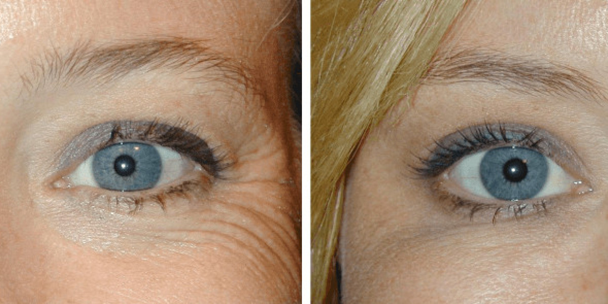 Ursachen und Entwicklung von Lachfalten