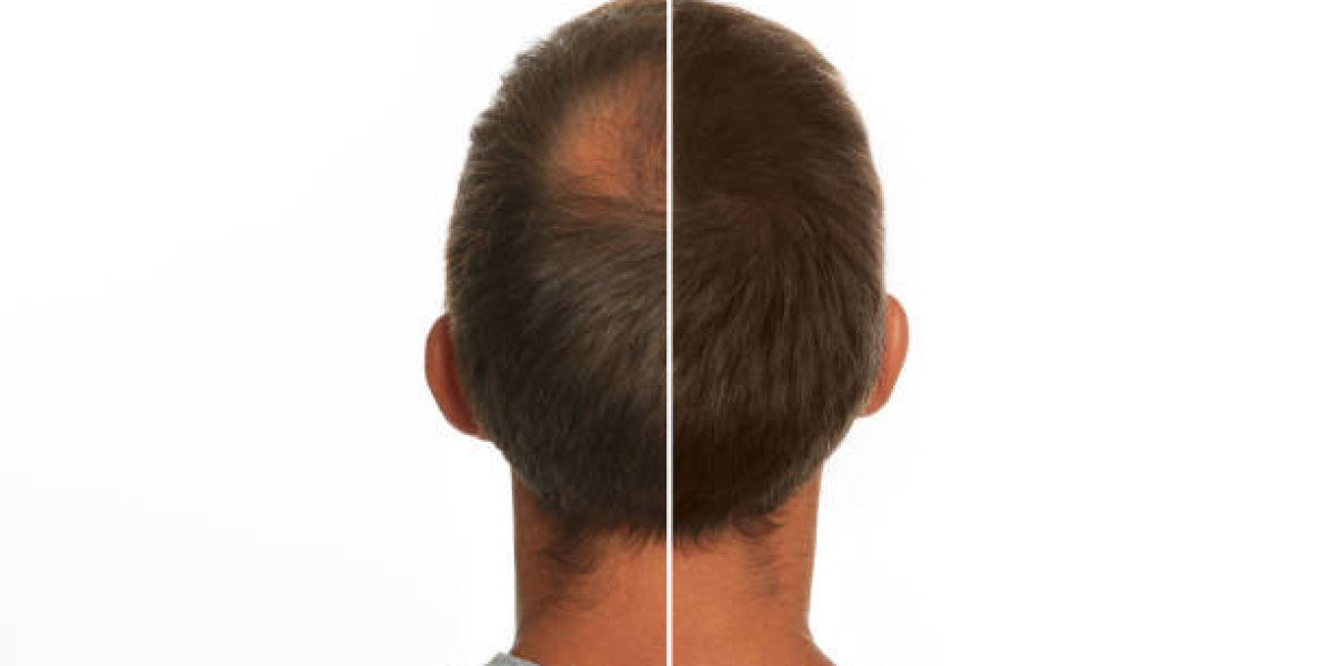 Lifestyle Changes Post-Hair Transplant for Lasting Results
