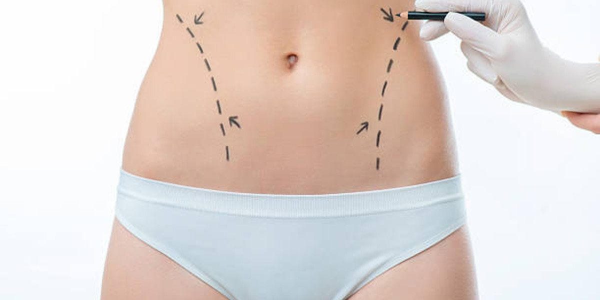 Liposuction for Love Handles: Sculpting a Balanced Silhouette