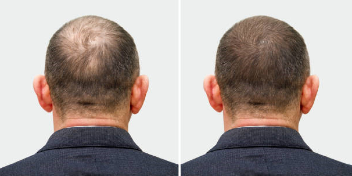 Is Hair Transplant Right for You in Saudi Arabia?
