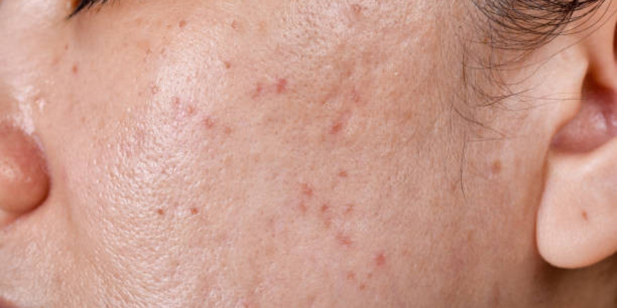 Acne Treatment Guide for Reducing Acne and Skin Imperfections