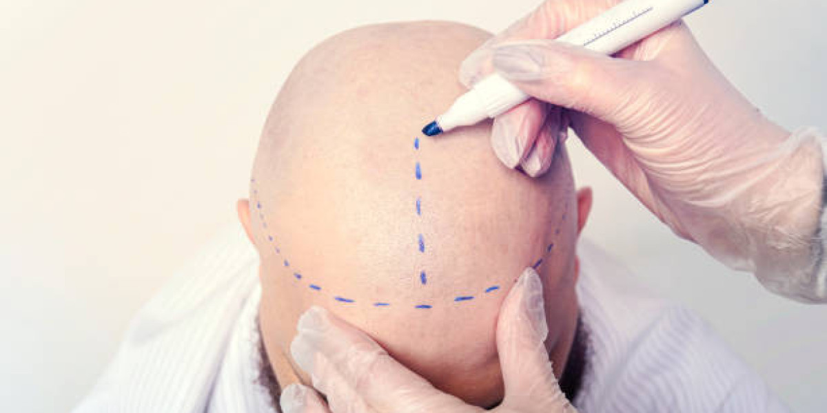 Hair Transplant Timeline: From Surgery Day to Full Results