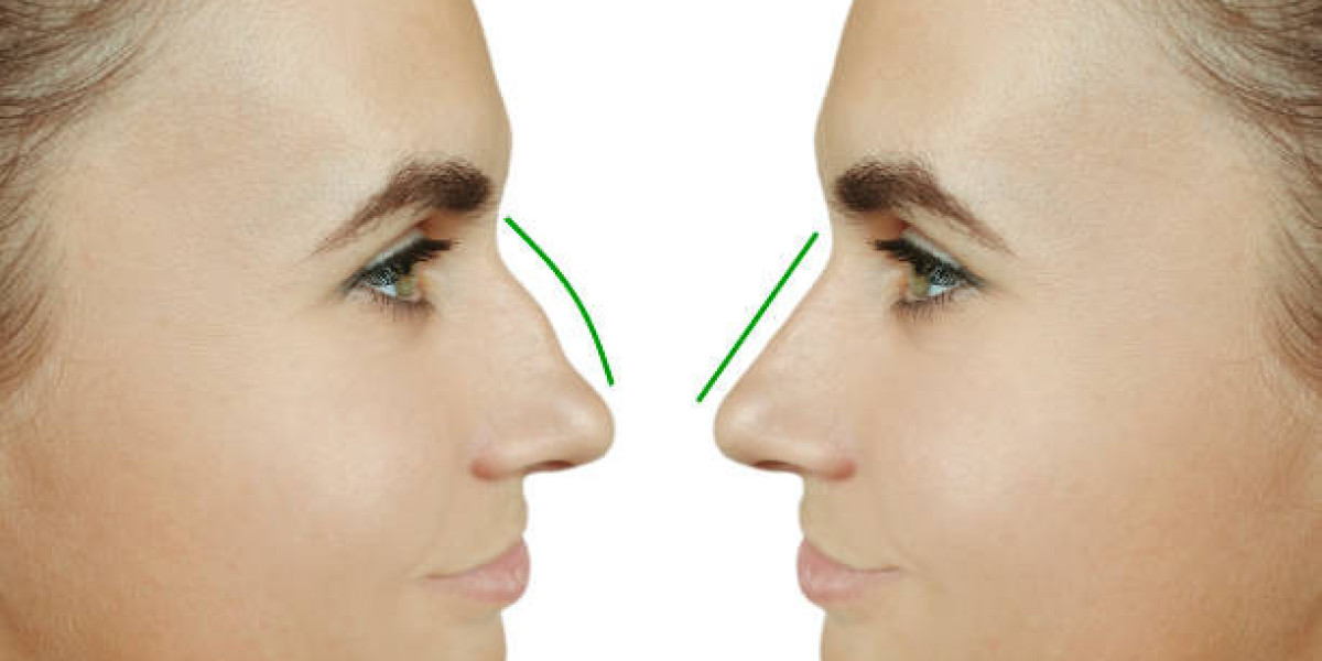 Rhinoplasty Consultation Prep: Questions to Ask Your Specialist