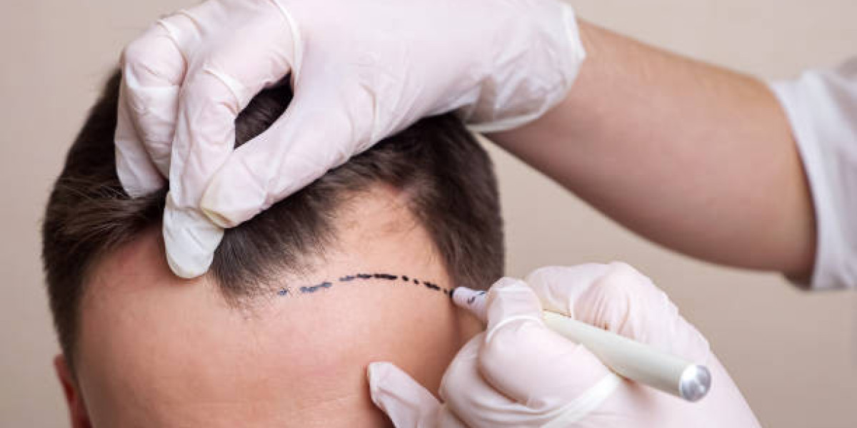 Seasonal Tips for Hair Transplant Recovery: Weather and Hair Growth