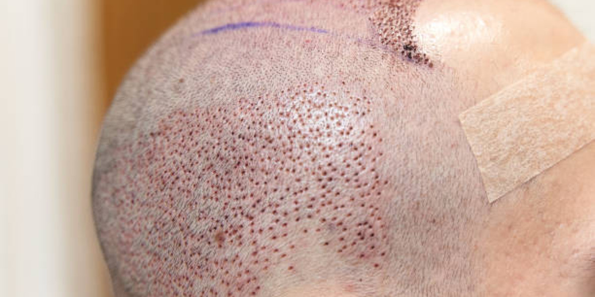 Who Qualifies for Hair Transplant? Eligibility and Expectations
