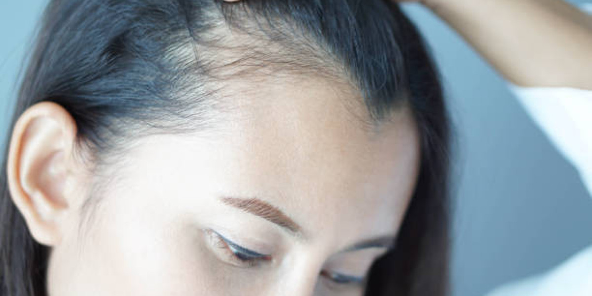 Exosomes Therapy for Hair Loss: A Smart Approach to Hair Recoveryc
