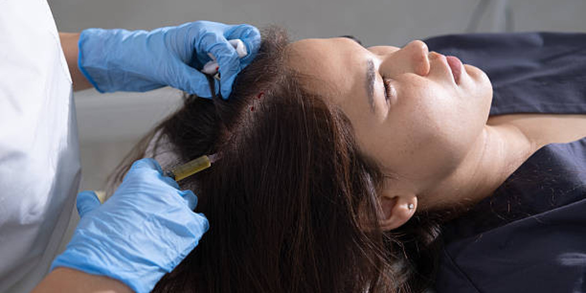 PRP Hair Treatment Breakthroughs in Modern Trichology