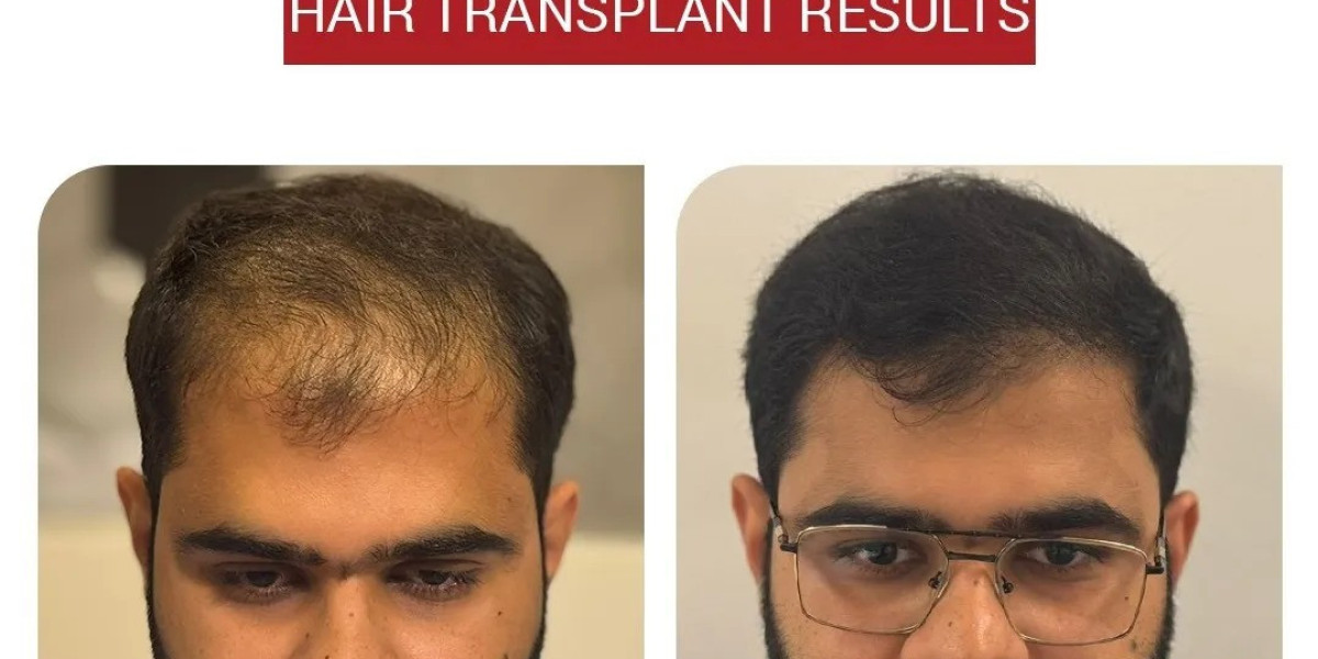 Natural Hairline Restoration Islamabad Hair Transplant Guide