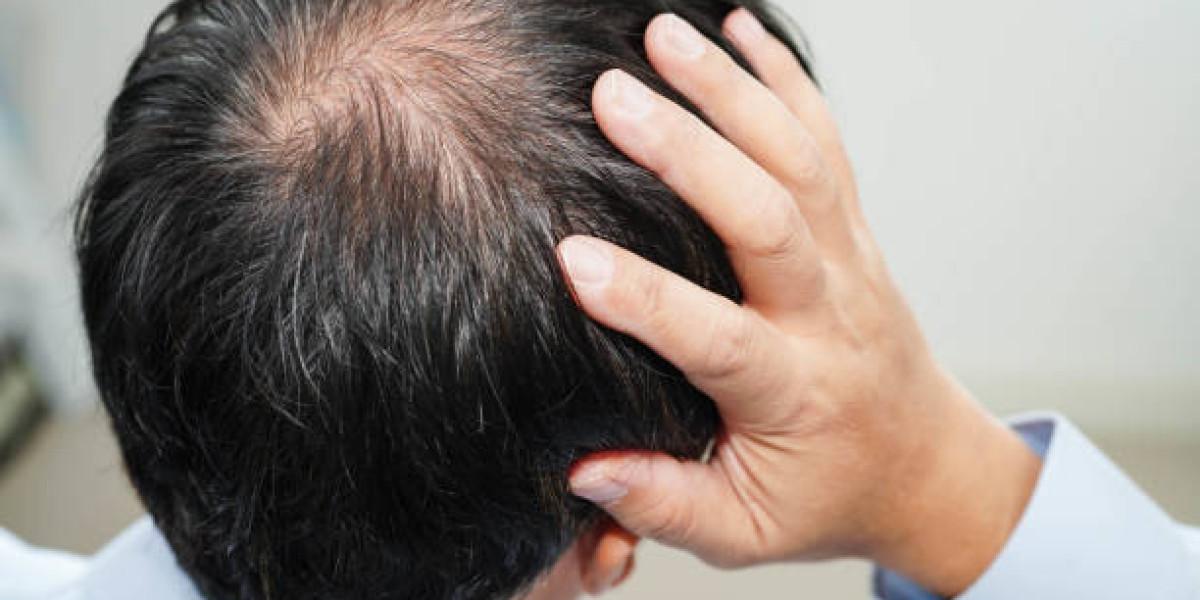 Hair Loss Treatment Plans for Healthy and Balanced Hair Growth