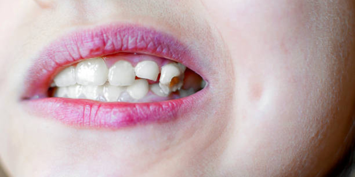 Patient Journey Guide for Tooth Fracture Treatment in Islamabad