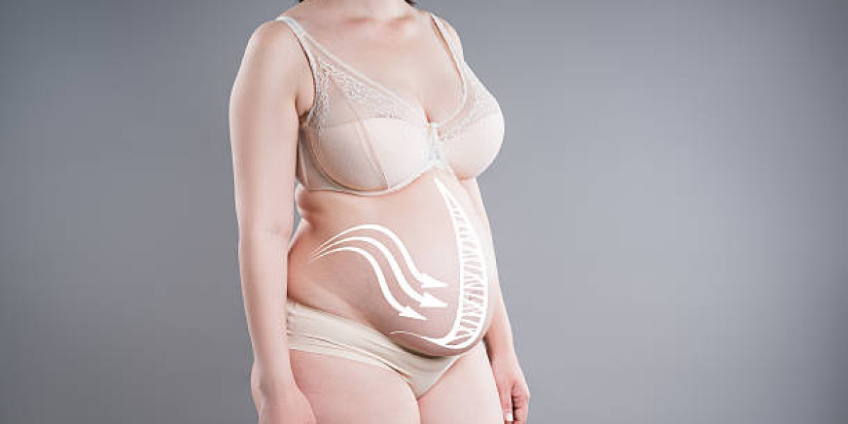 Tummy Tuck Surgery and Recovery Expectations Simplified
