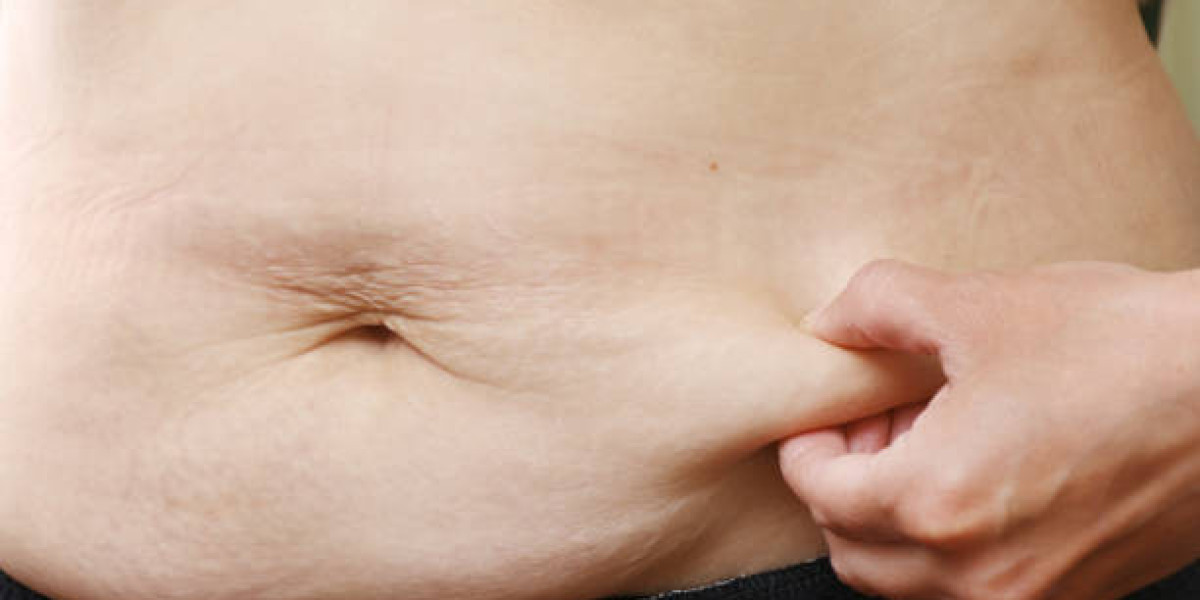 Tummy Tuck Surgery in Riyadh: What You Should Know Before Deciding