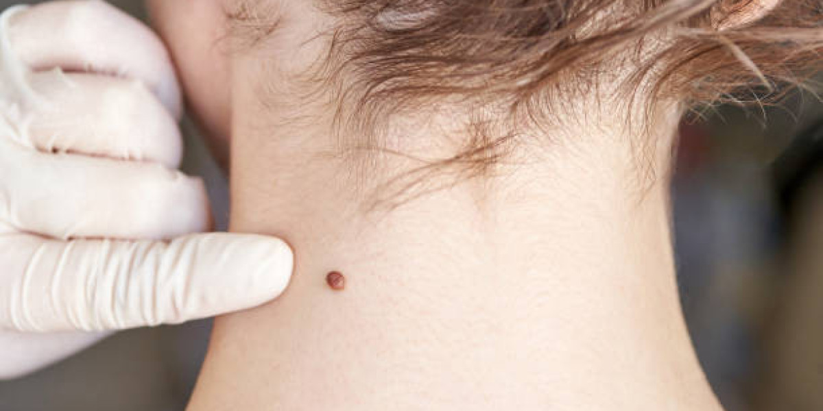 Best Wart Removal Options for Clear Skin Confidence
