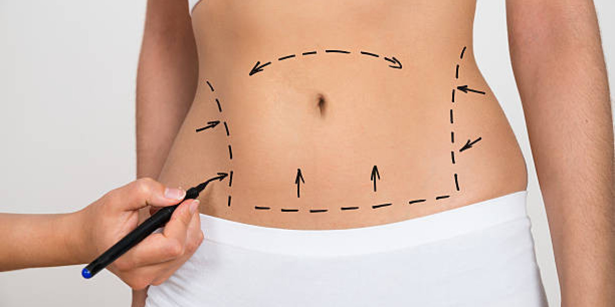 Liposuction for Targeted Fat Reduction Solutions