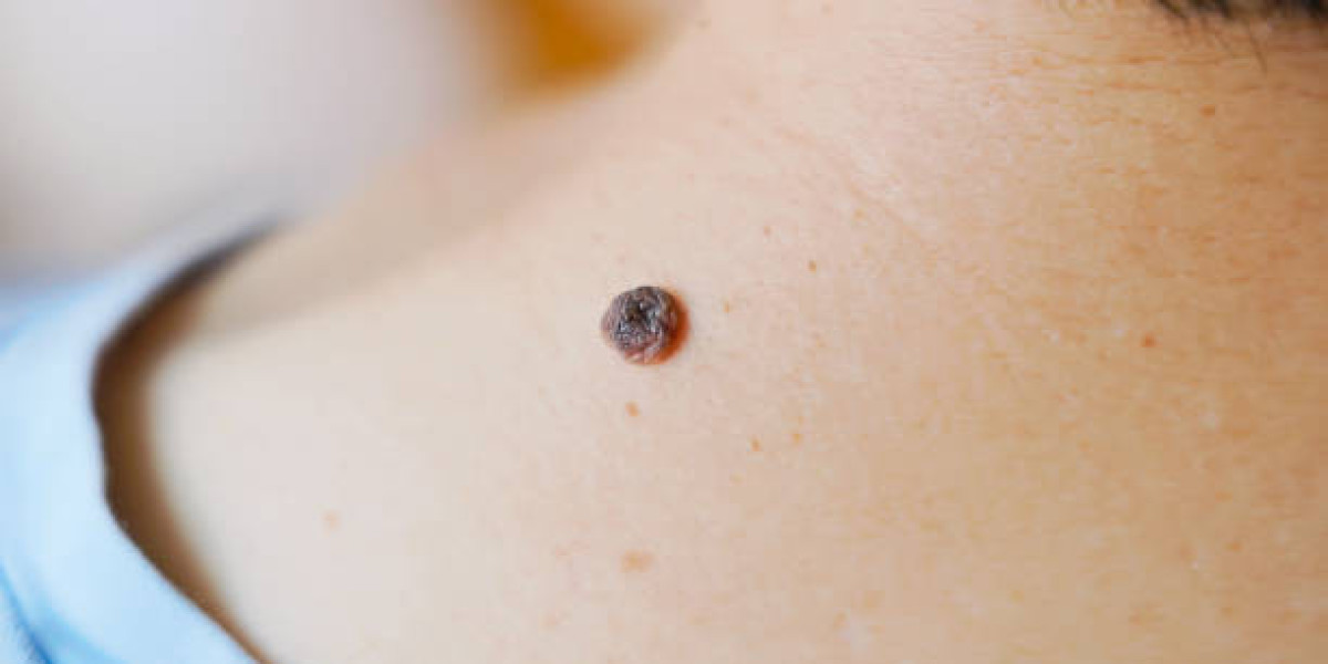 Learn About Safe Wart Removal for All Skin Types