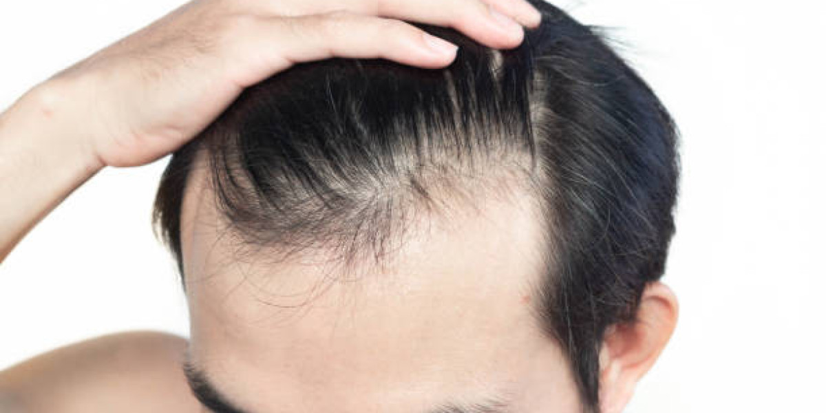 Hair Transplant Risks and How to Avoid Complications Effectively