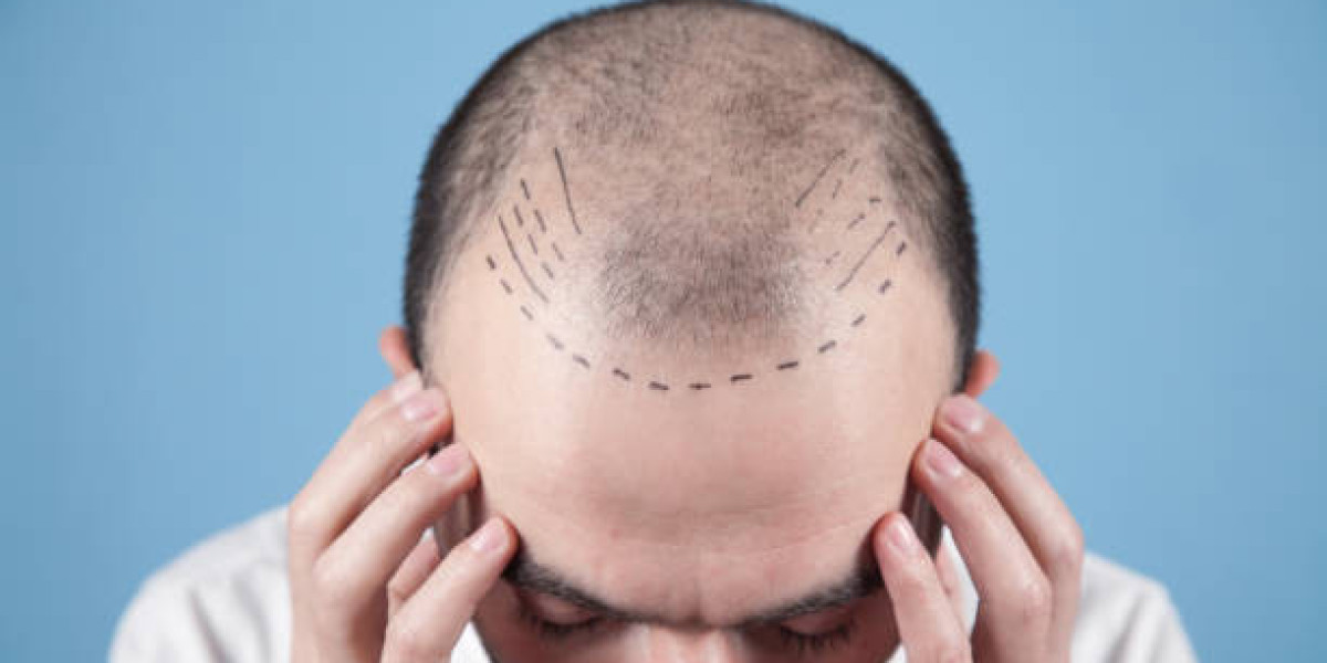 Hair Transplant Methods for Effective Hairline Design