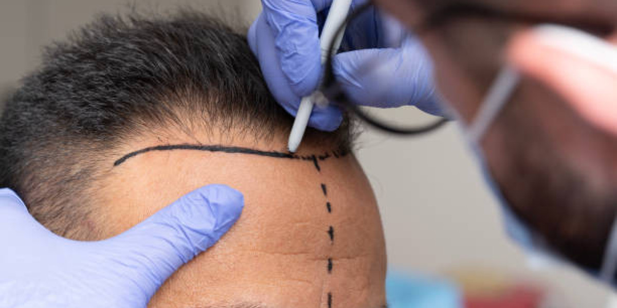 Hair Transplant Treatments for Hairline Restoration