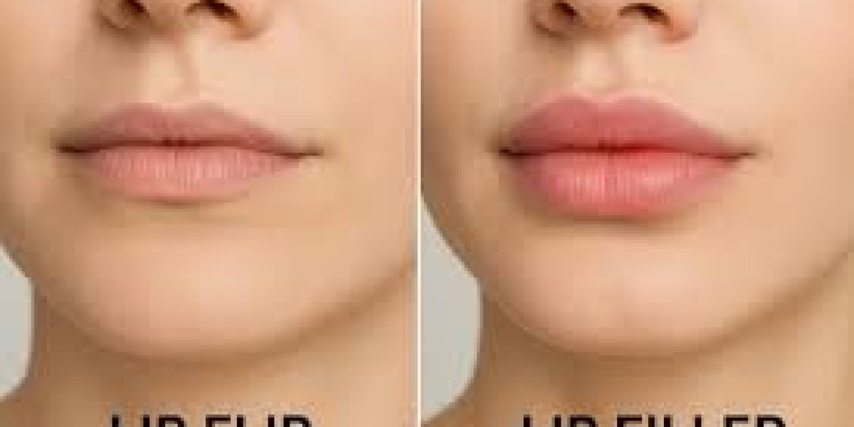 Lip Flip: Alles über die sanfte Lippenverschönerung
