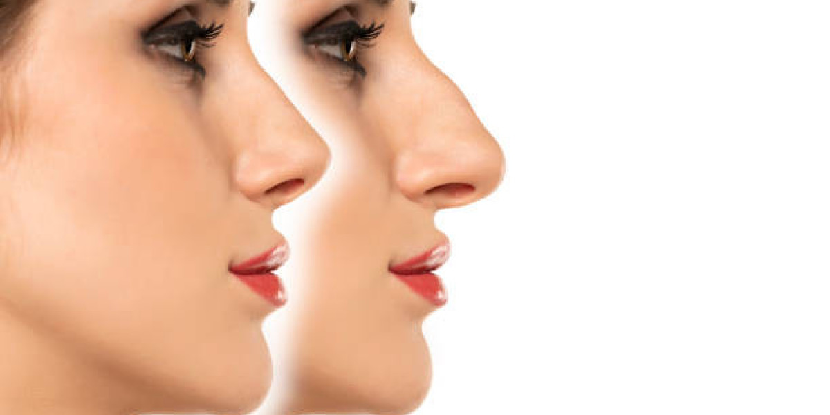 How to Approach Unrealistic Expectations Before Rhinoplasty Surgery