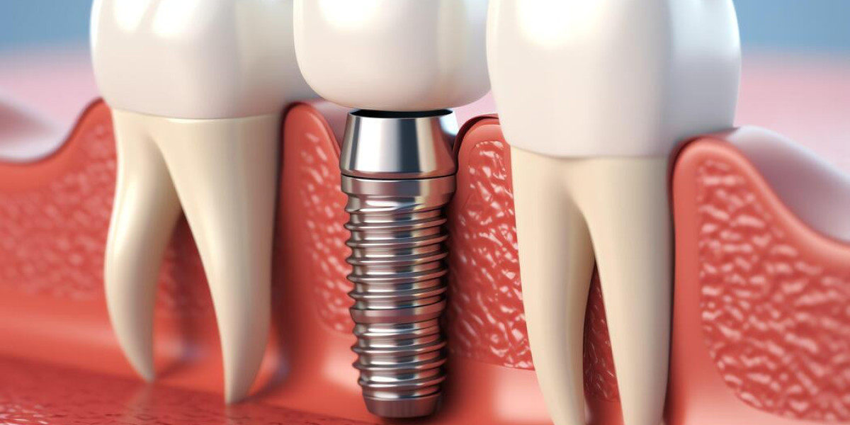 How Long Does the Dental Implant Procedure Take?