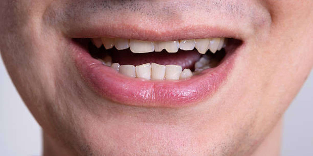 Tooth Fracture Treatment Cost in Pakistan (2026 Complete Guide)
