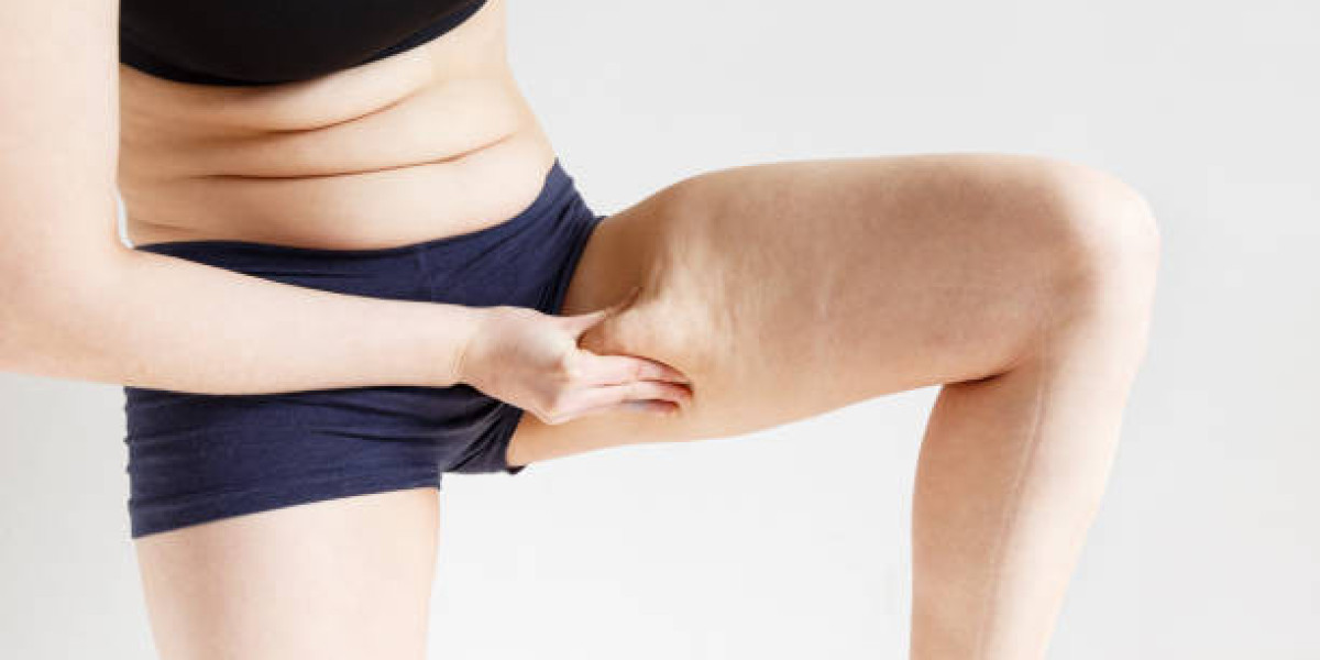 Lipedema Treatment Options for Enhanced Body Shape