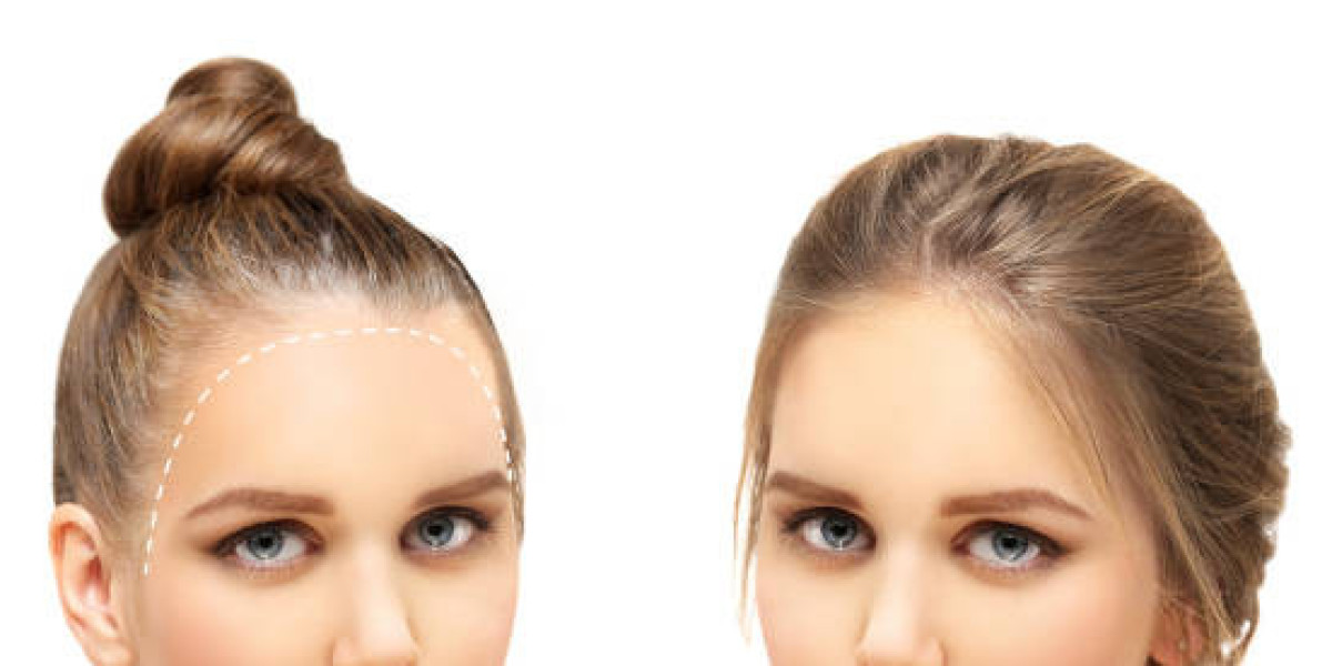 FUE Hair Transplant in Islamabad – Permanent Hair Regrowth with Advanced Modern Techniques
