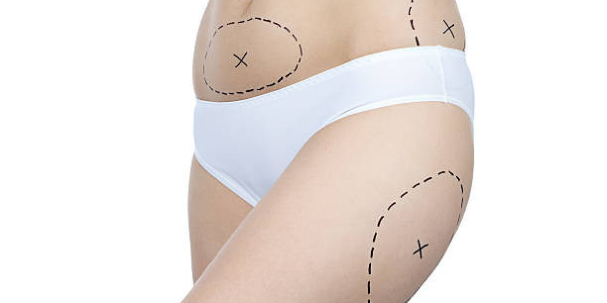 Liposuction Treatment for a More Sculpted Physique