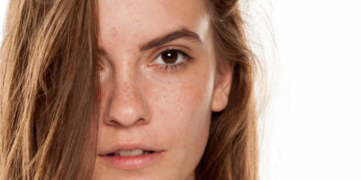 Pimples Treatment Solutions for Bright Facial Beauty