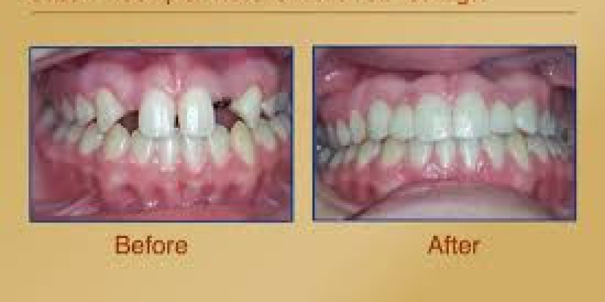 Dental Crowns: Restore, Protect, and Strengthen Your Teeth for a Healthy Smile