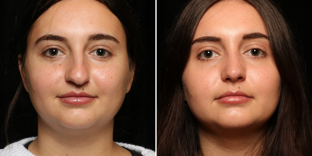 Rhinoplasty in Islamabad: A Modern Approach to Nose Reshaping