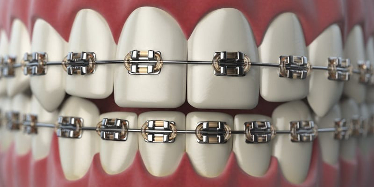 How Long Do Dental Braces Take to Straighten Teeth?