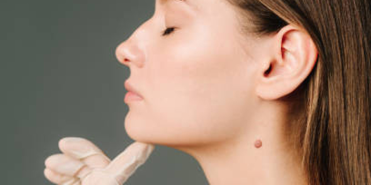 Skin Tag Removal Care for Natural Skin Perfection