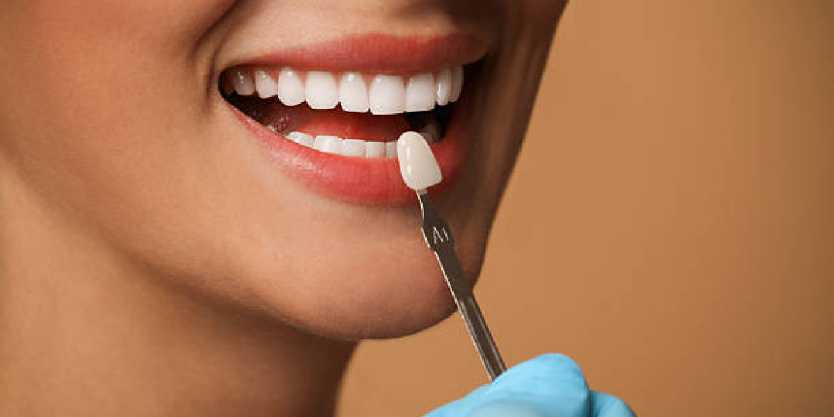 Daily Care Routine for Long-Lasting Results Dental Veneers in Pakistan: