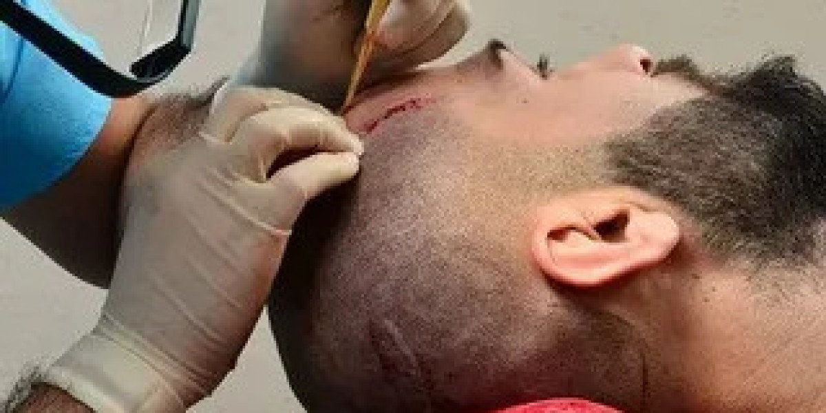 DHI Hair Transplant in Islamabad – A Modern Solution for Hair Restoration at Enfield Royal Clinic