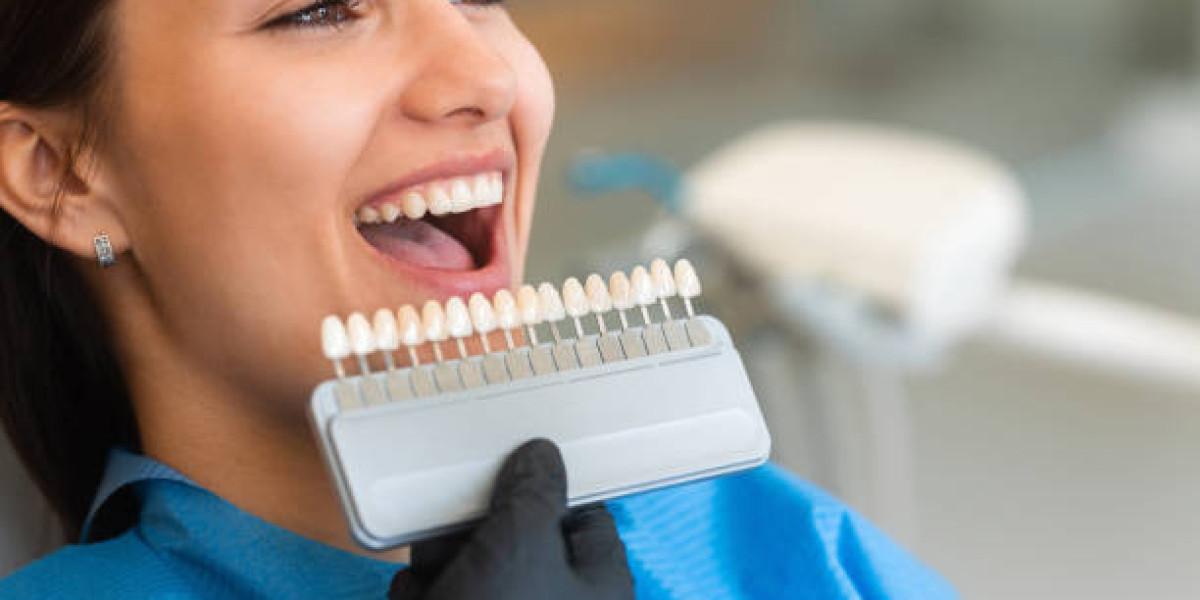 How Long They Really Last and What Affects Their Lifespan Dental Veneers in Islamabad Pakistan: