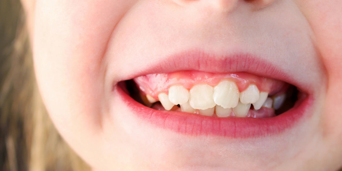 Problems Caused by Overlapping or Crooked Teeth