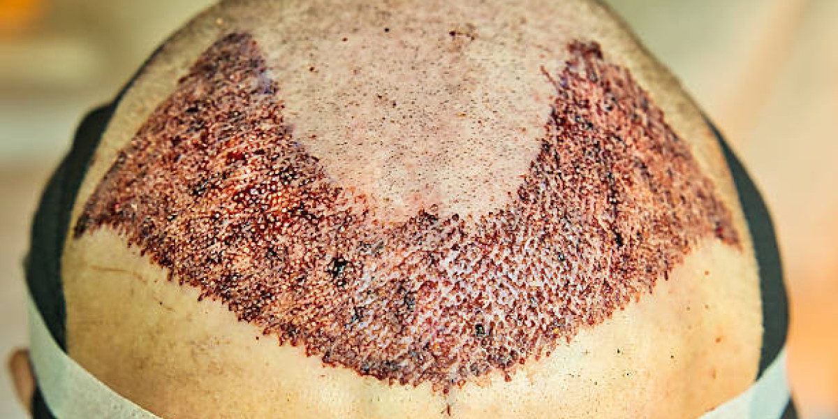 Managing Expectations for Hair Transplant Results