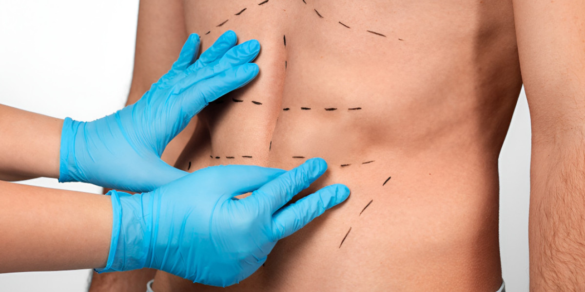 How Liposuction in Islamabad Helps Remove Stubborn Fat