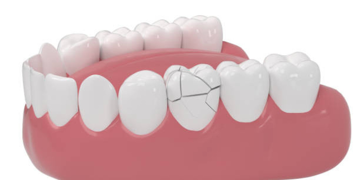 How Age Affects Tooth Fracture Risk and Treatment in Pakistan