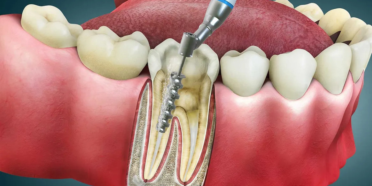 Root Canal Treatment: A Painless Way to Save Damaged Teeth