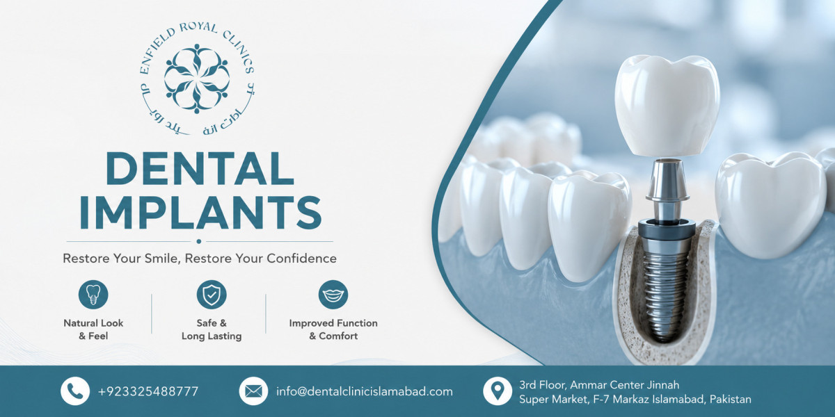 Best Dental Implants in Islamabad with Modern Techniques